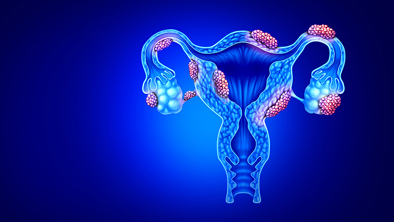 Ενδομητρίωση και σεξουαλική υγεία